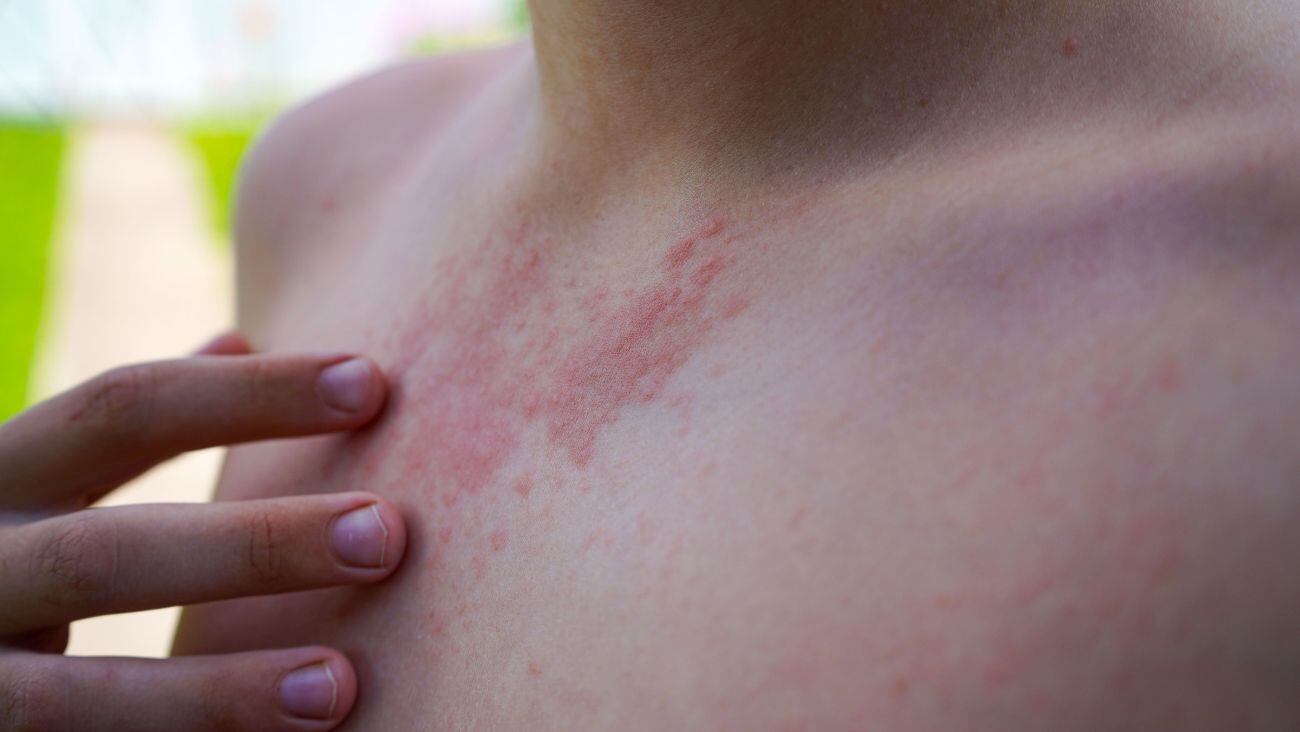 Pocos saben la razón de por qué las personas de 50 años no deben vacunarse contra el sarampión